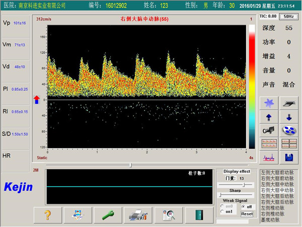 经颅多普勒软件PW模式下单窗口检测界面.jpg