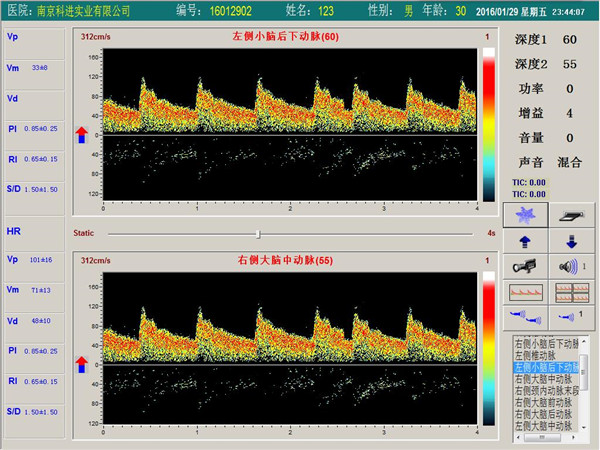 经颅多普勒双通道，单深度界面