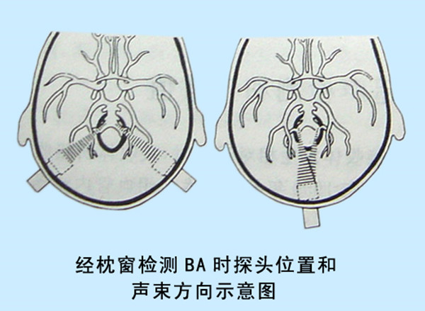 04经枕窗检测BA时探头位置和声束方向示意图.jpg