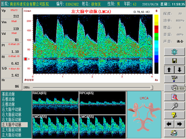 超声经颅多普勒狭窄血管频谱图.jpg