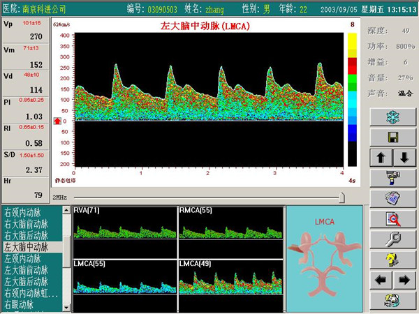 超声经颅多普勒痉挛血管频谱图.jpg