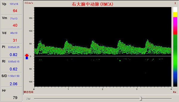 超声经颅多普勒对脑供血不足的血管频谱图.jpg