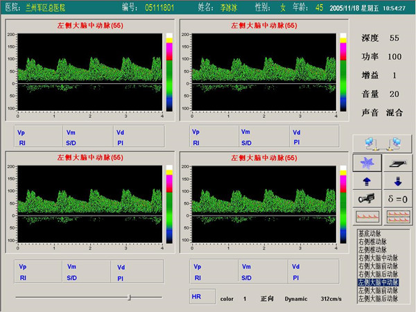 超声经颅多普勒血流分析仪四窗口（四深度）检测界面.jpg