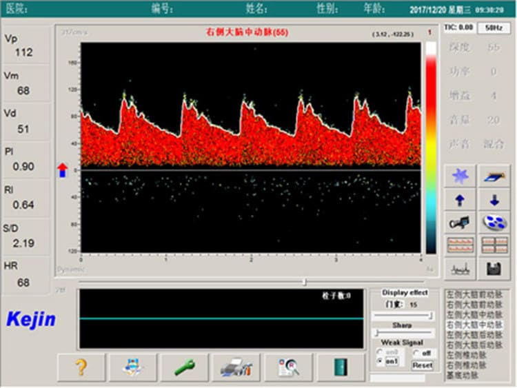 经颅多普勒超声检查界面