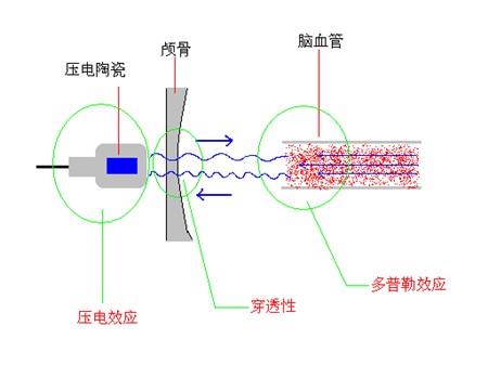 脑彩超仪（TCD仪）的原理