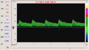 TCD检测脑供血不足的频谱图像.jpg