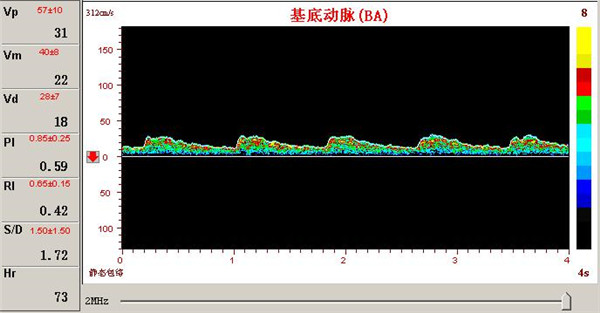 椎一基底动脉供血不足.jpg