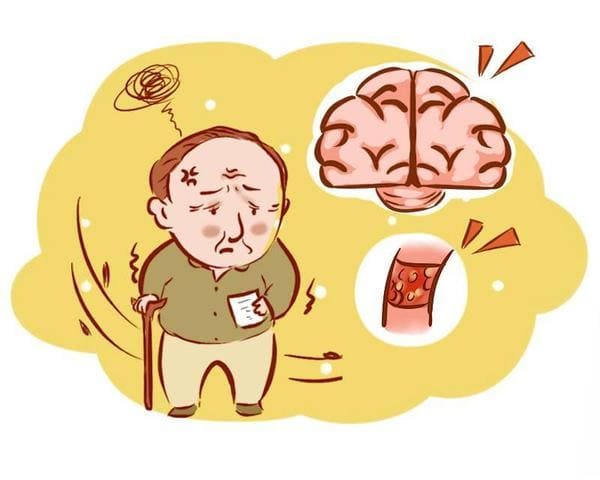 脑血栓的发生前兆有哪些