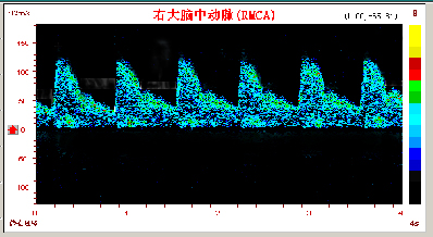 脑动脉硬化的TCD表现和常见疾病