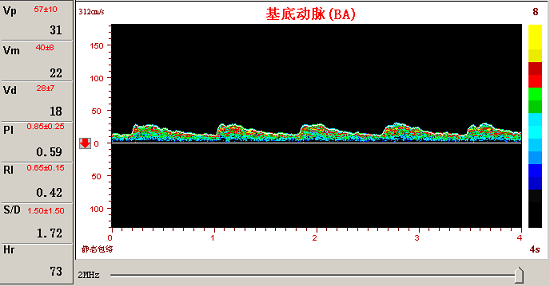 经颅多普勒对椎─基底动脉的