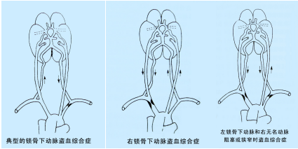 锁骨下动脉盗血综合征超声TCD表现