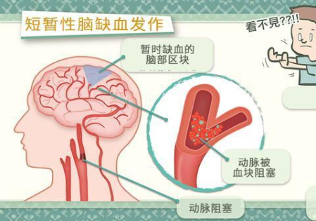 短暂性脑缺血是什么 经颅多普勒可确诊