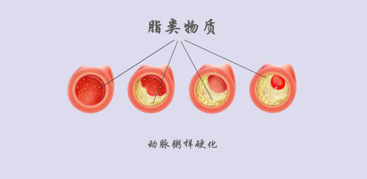 颅内动脉粥样硬化与缺血性脑卒中的关系