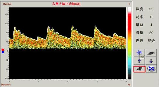 正常脑血管多普勒频谱及各血流参数