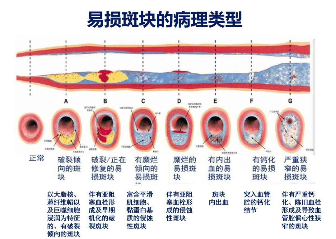 易损斑块是缺血性卒中发生的独立危险因素